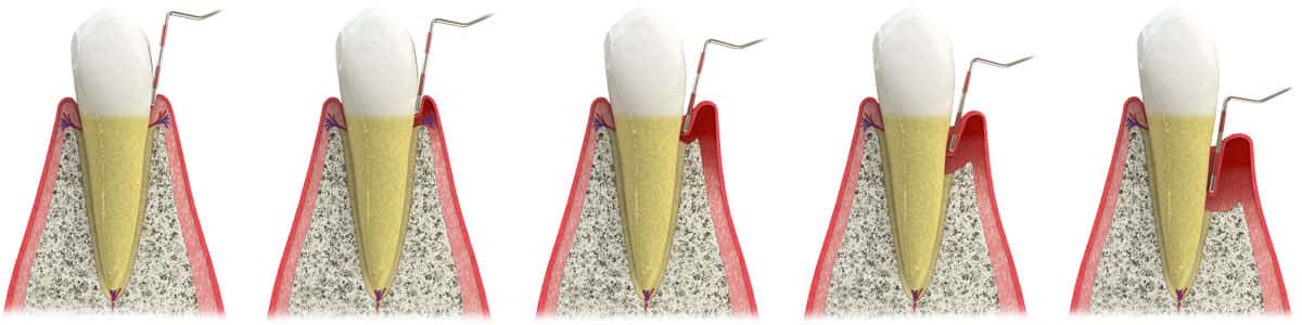 Stages of Periodontal Disease in Bolingbrook, IL